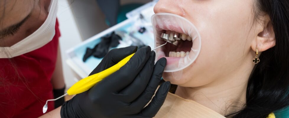 how teeth caps improve function comfort and confidence