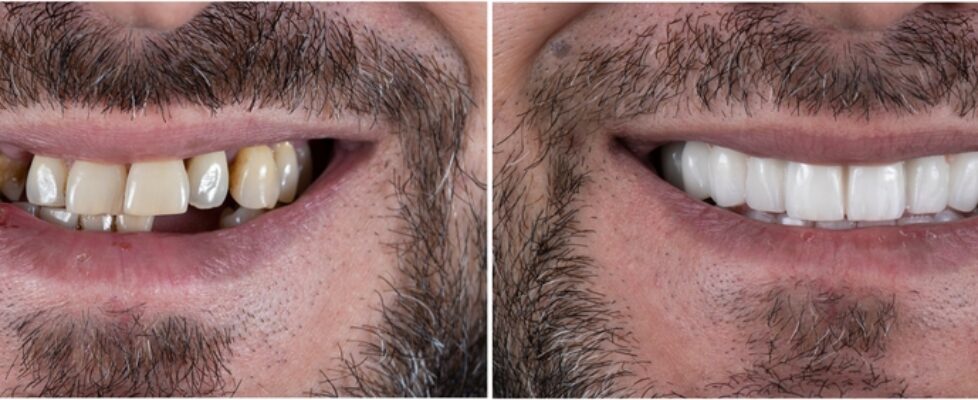 understanding the difference between dental crowns and bridges